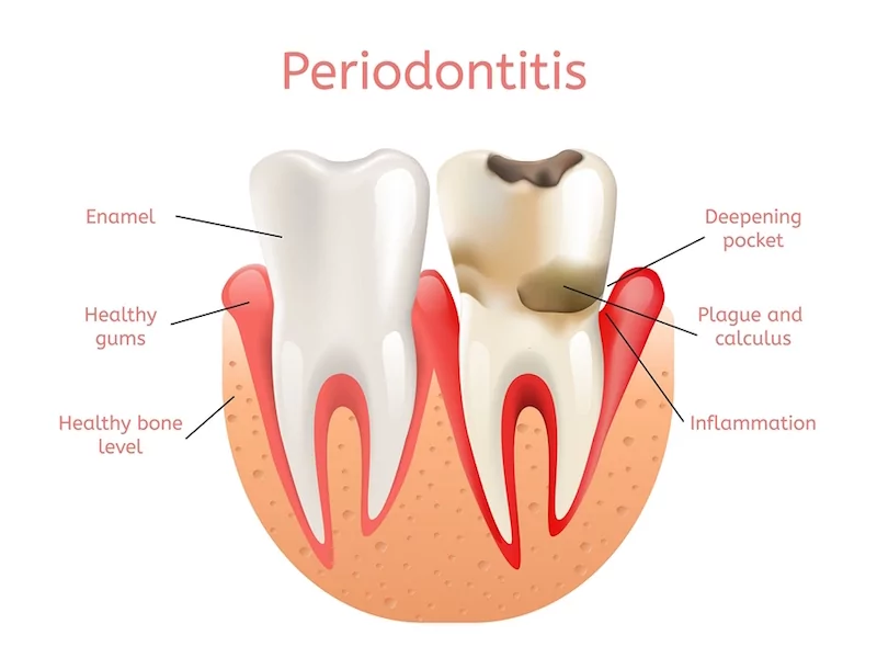 prevent gum disease Rockwall