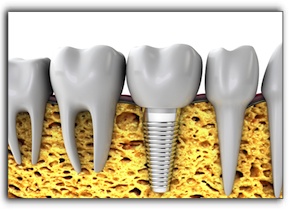 Royse City tooth implants