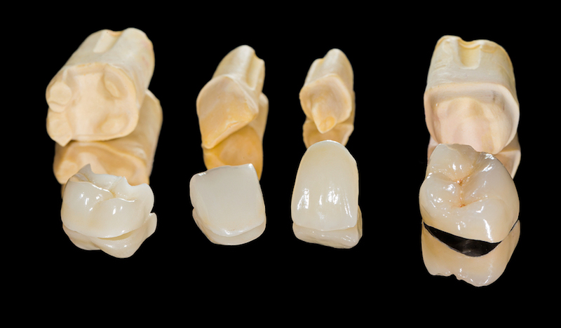 dental crowns Rockwall