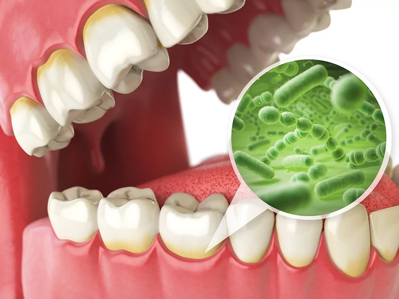 four stages of gum disease Rockwall