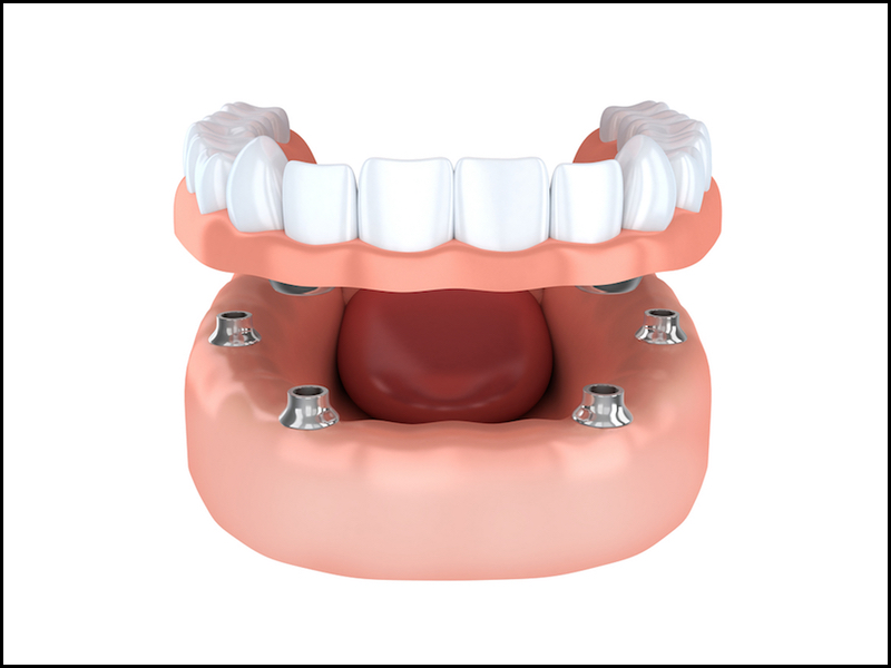 implant dentures Rockwall