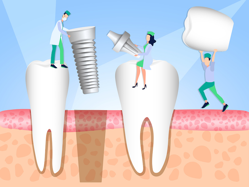 why does a tooth implant take several months? Rockwall