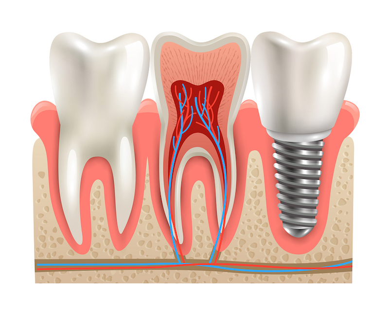 dental implants Rockwall