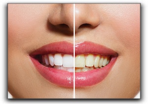 affordable teeth bleaching Rockwall