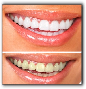 Rockwall teeth whitening