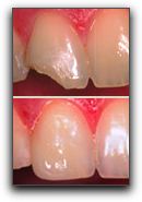 Dental Crowns at Karen E Williamson D.D.S., P.A in Rockwall