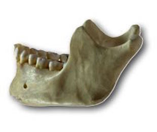 Rockwall Jaw Bone Deterioration