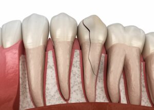 Chipped Tooth Repair - Cracked Tooth Repair - Broken Tooth Repair - Karen Williamson DDS Rockwall TX