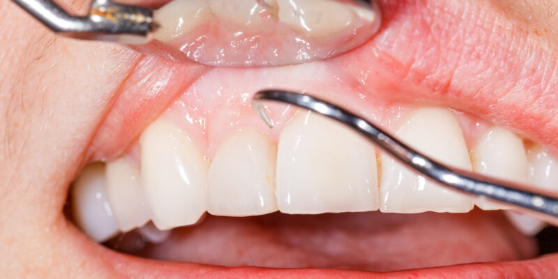 doctor examining receding gums in Rockwall