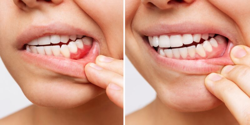 side by side of gum disease progression