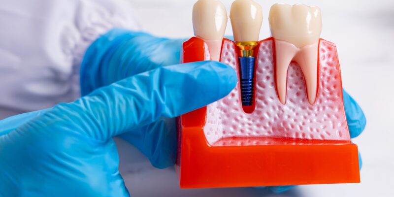 closeup, dentist in blue gloves pointing to an implant model